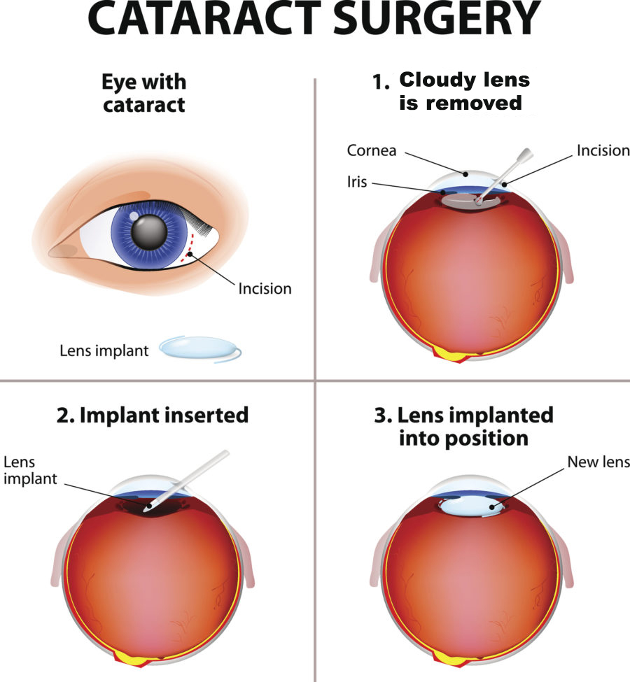 Explain Cataract Surgery