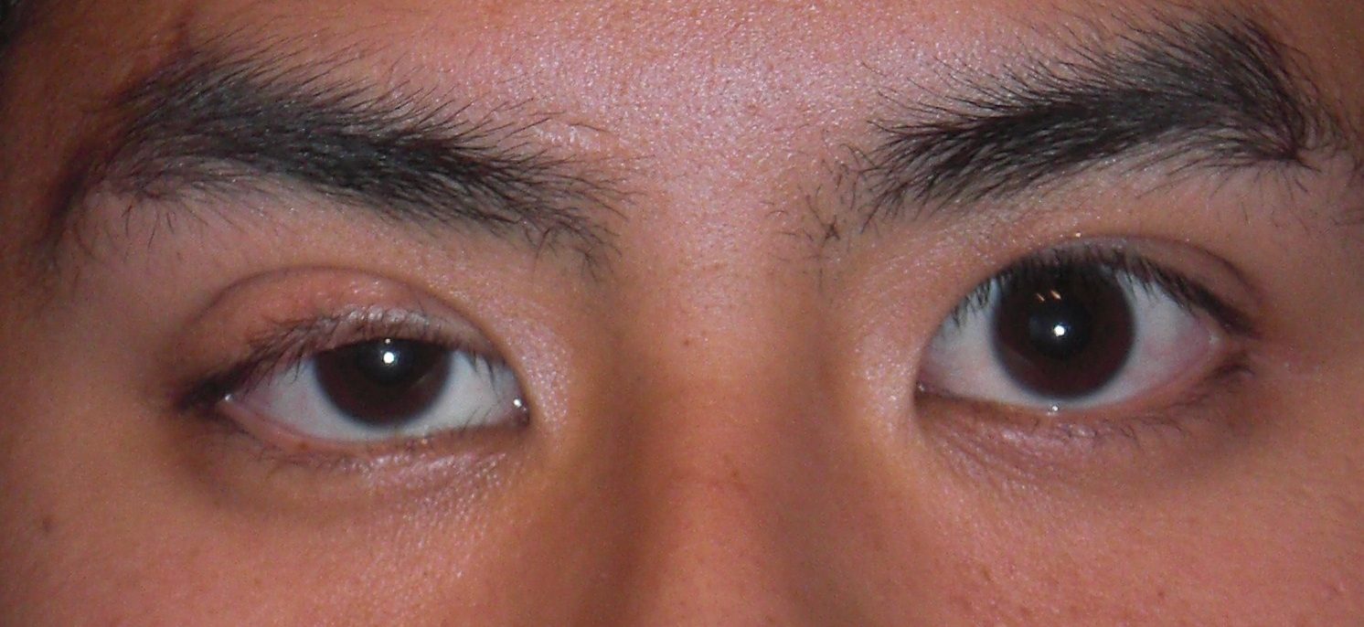 Глаза стали разного. Полная офтальмоплегия.