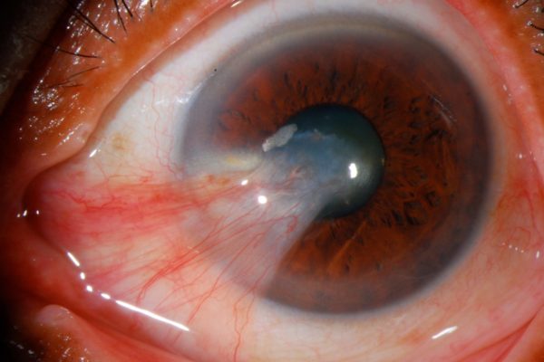 Eye Surgery For Cataracts, Pterygiums, Eyelid Lesions And Ptosis - ACE